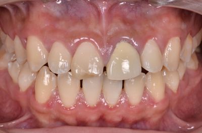 before ６オールセラミッククラウンと<br>ダイレクトボンディングによる<br>歯の形態と色調の改善