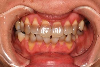 before ラミネートベニア修復による<br>変色歯の改善