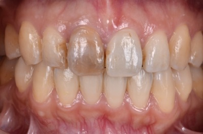 before オールセラミック修復による<br>歯の色調と形態の改善