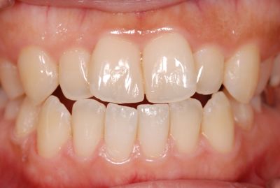 before １４前歯部の複数箇所にわたるコンポジットレジン治療