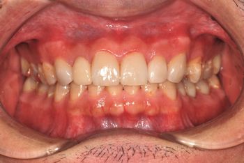 before 全顎的な虫歯治療と前歯部のラミネートベニア修復