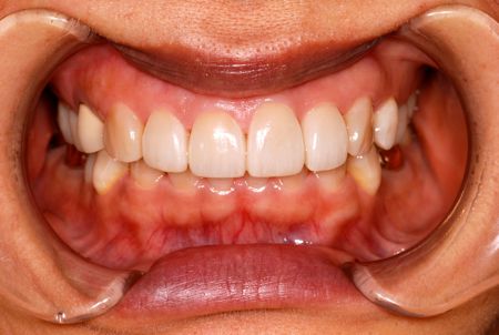 before ラミネートベニア修復による歯の角度及び破折の改善