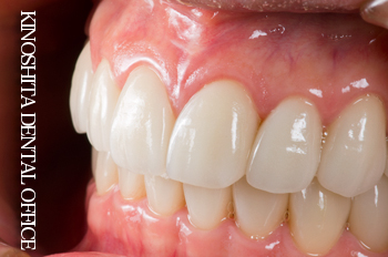 after ２オールセラミック修復による<br>歯の色調、形態、噛み合わせの総合治療