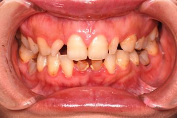 before ラミネートベニア修復による歯の大きさの改善
