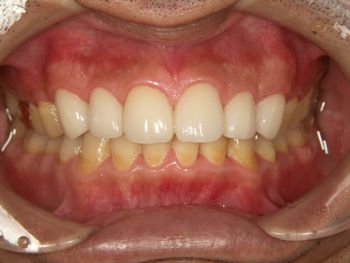 after ラミネートベニア修復による虫歯と歯の角度の改善