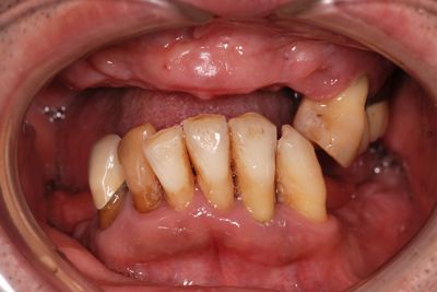 before １５重度の歯周病を精密審美義歯にて修復
