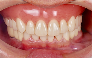 after 上顎を総入れ歯、下顎をインプラントおよびオールセラミック治療で修復した治療例