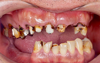 before 上顎を総入れ歯、下顎をインプラントおよびオールセラミック治療で修復した治療例